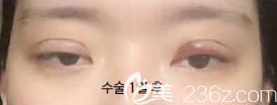 韓國美麗的人雙眼皮+開眼角+眼部吸脂案例術后恢復效果圖 韓國美麗的人雙眼皮+開眼角+眼部吸脂案例術后恢復效果圖