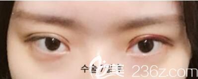 韓國美麗的人雙眼皮+開眼角案例術后7天恢復圖 韓國美麗的人雙眼皮+開眼角案例術后7天恢復圖