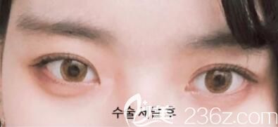 考慮韓國和國內(nèi)雙眼皮技術(shù)差別找韓國美麗的人整形外科做眼綜合案例術(shù)后1個月恢復(fù)效果圖