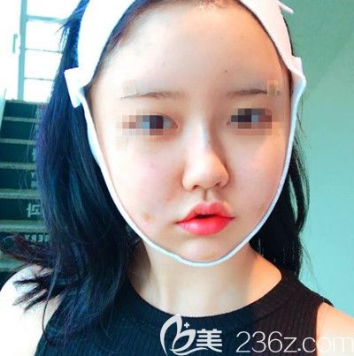 在韓國(guó)DI整形醫(yī)院做面部吸脂+墊下巴手術(shù)當(dāng)天 在韓國(guó)DI整形醫(yī)院做面部吸脂+墊下巴手術(shù)當(dāng)天