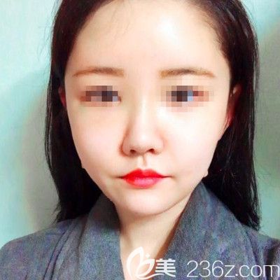 在韓國(guó)DI整形醫(yī)院做面部吸脂+墊下巴手術(shù)后9天 在韓國(guó)DI整形醫(yī)院做面部吸脂+墊下巴手術(shù)后9天