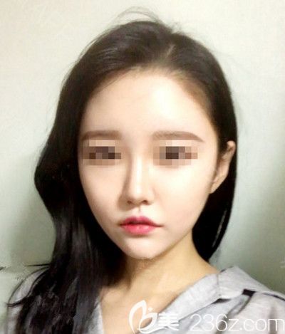 在韓國(guó)DI整形醫(yī)院做面部吸脂+墊下巴手術(shù)后1個(gè)月 在韓國(guó)DI整形醫(yī)院做面部吸脂+墊下巴手術(shù)后1個(gè)月