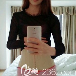 汪洋主任幫我做腰腹吸脂術(shù)后即刻 汪洋主任幫我做腰腹吸脂術(shù)后即刻