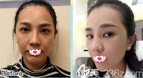 邯鄲雅麗六月顏值青春季推出超多整形優(yōu)惠 韓式生料假體隆鼻和埋線提升都是1980元