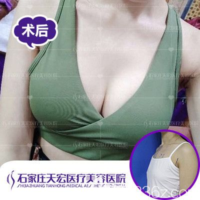 天宏整形醫(yī)院做復(fù)合隆胸案例