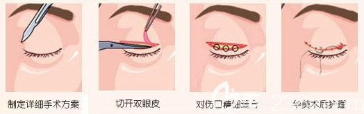 汕頭華美雙眼皮手術(shù)過程圖 汕頭華美雙眼皮手術(shù)過程圖