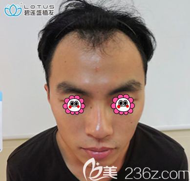 在北京碧蓮盛做額角種植和發(fā)際線修復前樣子 在北京碧蓮盛做額角種植和發(fā)際線修復前樣子