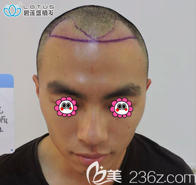 在北京碧蓮盛做額角種植和發(fā)際線修復設計照 在北京碧蓮盛做額角種植和發(fā)際線修復設計照