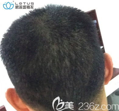 我在北京碧蓮盛做額角種植和發(fā)際線修復一個月后枕部樣子 我在北京碧蓮盛做額角種植和發(fā)際線修復一個月后枕部樣子