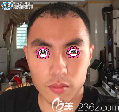 北京碧蓮盛額角種植和發(fā)際線修復案例 北京碧蓮盛額角種植和發(fā)際線修復案例