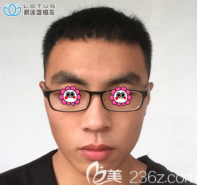 我是在北京專門做植發(fā)的醫(yī)院北京碧蓮盛做了額角種植和發(fā)際線修復(fù)