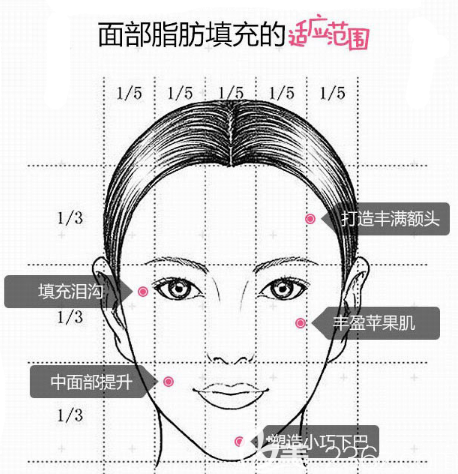 汕頭華美面部脂肪填充適應(yīng)范圍圖解