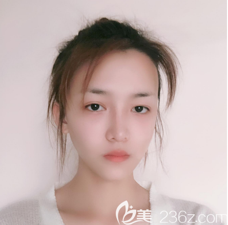 術(shù)前雙眼皮不對(duì)稱照片 術(shù)前雙眼皮不對(duì)稱照片