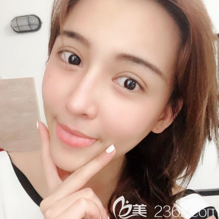 廣州美萊陳貴宗醫(yī)生雙眼皮不對(duì)稱修復(fù)案例 廣州美萊陳貴宗醫(yī)生雙眼皮不對(duì)稱修復(fù)案例