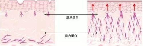 韓國清譚優(yōu)面部提升原理 韓國清譚優(yōu)面部提升原理