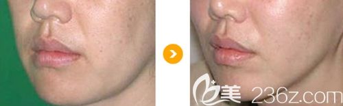 韓國清譚優(yōu)韓面部埋線提升案例 韓國清譚優(yōu)韓面部埋線提升案例