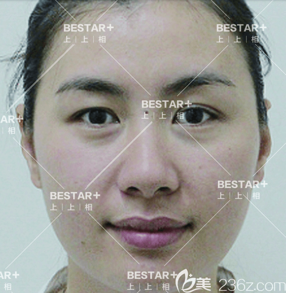 在北京上上相做蜂巢明星藝術(shù)面雕和雙眼皮手術(shù)前樣子 在北京上上相做蜂巢明星藝術(shù)面雕和雙眼皮手術(shù)前樣子
