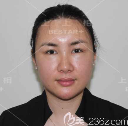 鄭楚蓉醫(yī)生給我做蜂巢明星藝術(shù)面雕和雙眼皮手術(shù)第8天效果 鄭楚蓉醫(yī)生給我做蜂巢明星藝術(shù)面雕和雙眼皮手術(shù)第8天效果