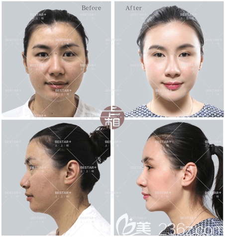 咨詢了北京上上相鄭楚蓉整形價格后我做了蜂巢明星藝術(shù)面雕和雙眼皮手術(shù)