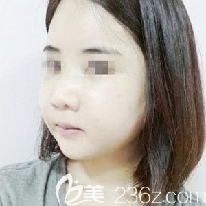 我在韓國(guó)必嫵做納米雙顎手術(shù)+額頭填充+隆鼻術(shù)后恢復(fù)