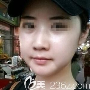 我在韓國(guó)必嫵做納米雙顎手術(shù)+額頭填充恢復(fù)情況