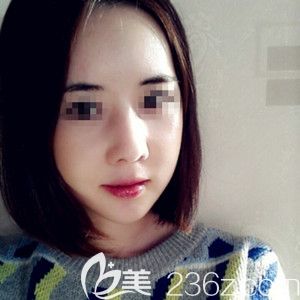 我在韓國(guó)必嫵做納米雙顎手術(shù)+額頭填充術(shù)后實(shí)例