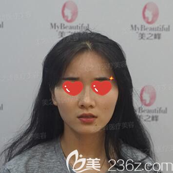 在長沙美之峰做玻尿酸豐下巴術(shù)前照 在長沙美之峰做玻尿酸豐下巴術(shù)前照