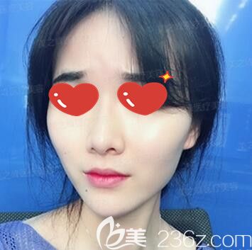 進(jìn)行伊婉C玻尿酸豐下巴術(shù)后3天效果 進(jìn)行伊婉C玻尿酸豐下巴術(shù)后3天效果