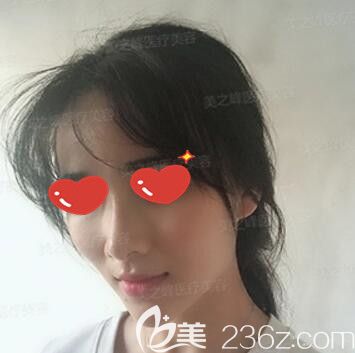 在長沙美之峰做玻尿酸豐下巴術(shù)后10天效果 在長沙美之峰做玻尿酸豐下巴術(shù)后10天效果