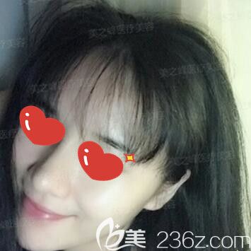 在長沙美之峰做玻尿酸豐下巴術(shù)后20天 在長沙美之峰做玻尿酸豐下巴術(shù)后20天