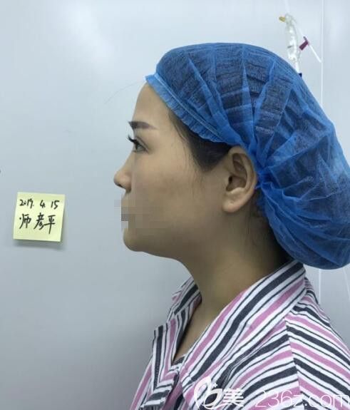 在鄭州藝齡做鼻綜合前 在鄭州藝齡做鼻綜合前