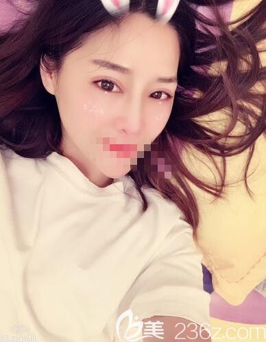 在鄭州藝齡做鼻綜合21天 在鄭州藝齡做鼻綜合21天