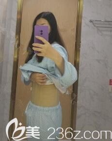 剛做完腰腹部吸脂術(shù)后即刻<span style= 剛做完腰腹部吸脂術(shù)后即刻<span style=