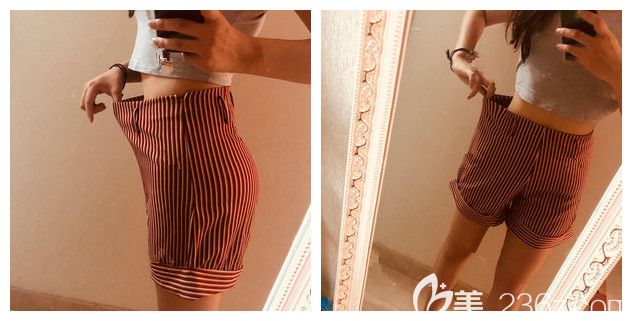 親身經(jīng)歷過腰腹吸脂才知道要分八個部位吸脂 在全麻手術(shù)后一個月可以明顯看到以前的褲子腰圍變大