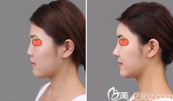 美國(guó)射極峰膨體隆鼻案例