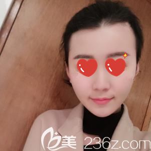 做光纖溶脂瘦臉術(shù)后16天臉部紅腫消失 做光纖溶脂瘦臉術(shù)后16天臉部紅腫消失