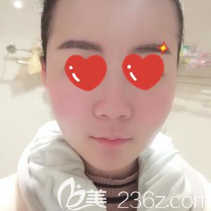 汪洋主任幫我做光纖溶脂術(shù)后效果 汪洋主任幫我做光纖溶脂術(shù)后效果