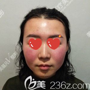 到武漢美基元做光纖溶脂瘦臉術(shù)前自己的大餅?zāi)? alt=