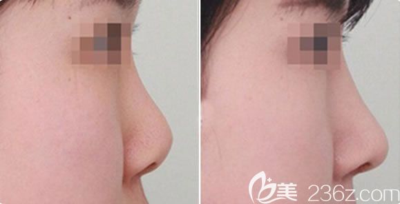 美男菲思挺膨體隆鼻案例