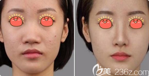 國(guó)產(chǎn)立秀膨體隆鼻真人案例