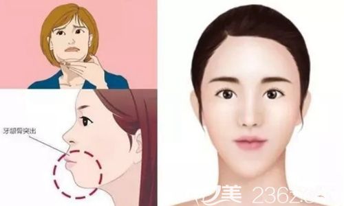 韓國三鄂輪廓術(shù)<span style=