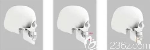 韓國雙鄂手術(shù)原理 韓國雙鄂手術(shù)原理