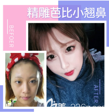 貴州利美康隆鼻好不好