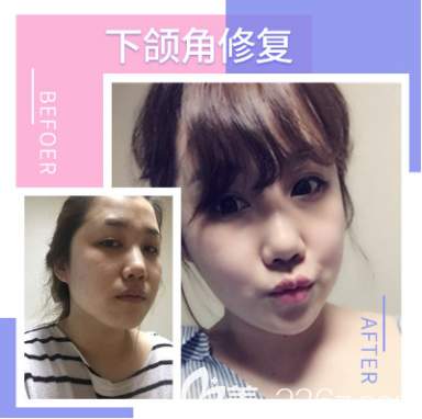 <!--<i data=20240703-sp></i>-->下頜角整形案例