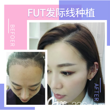 <!--<i data=20240703-sp></i>-->發(fā)際線種植案例