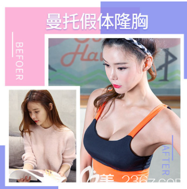 <!--<i data=20240703-sp></i>-->曼托假體豐胸案例