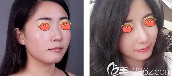 信晟假體隆鼻真人案例效果