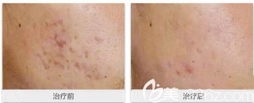 在十堰安琪兒激光嫩膚祛痘真人案例效果