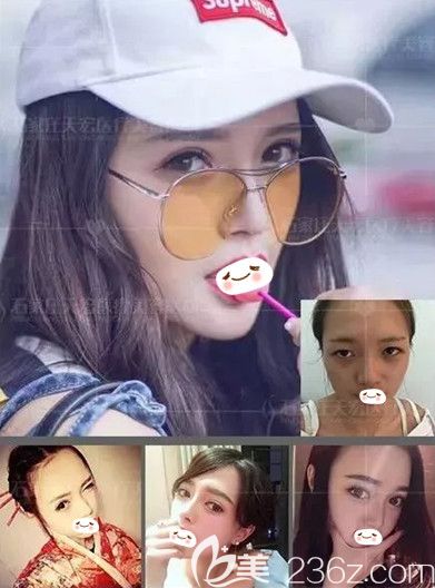 天宏整形做雙眼皮手術(shù)案例