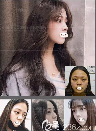 石家莊天宏做鼻綜合整形案例